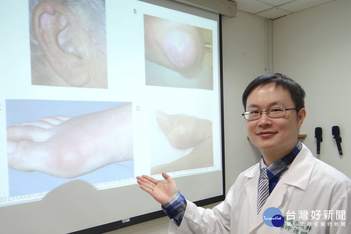 痛風問題勿輕忽　醫師：輕食、運動、吃藥控制缺一不可