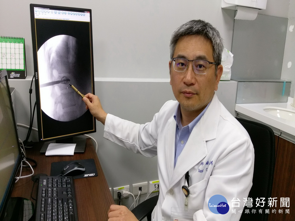 暴裂性骨折免打骨釘　撐開椎體灌骨水泥復原快