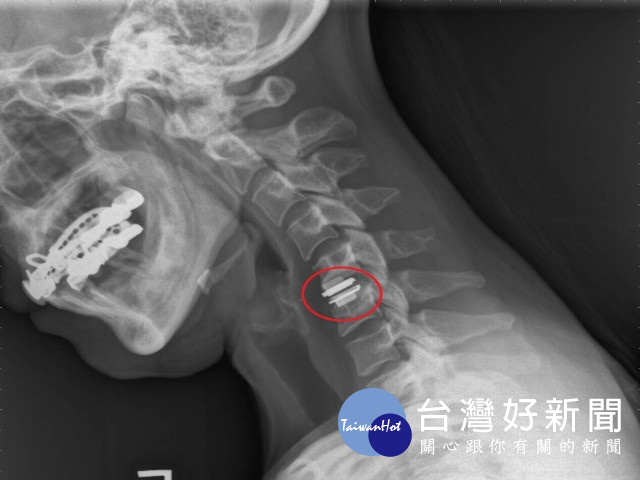 創新「微創腰椎手術」解決頸腰背舊疾　揮別大傷口傳統刀