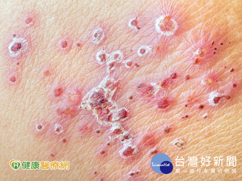 皮蛇纏身　民俗療法醜一生？！