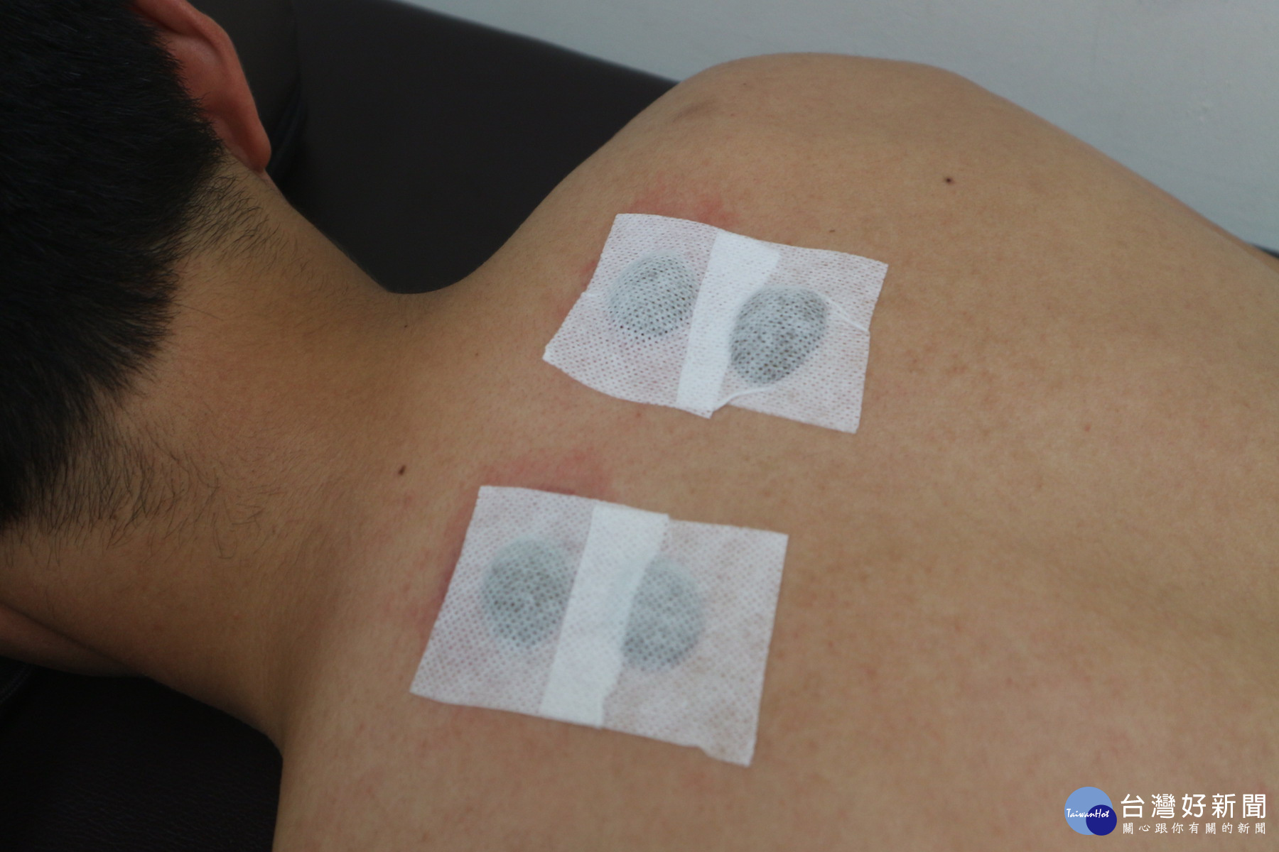 冬病夏治　三伏貼中醫外治法輔助將治過敏性鼻炎