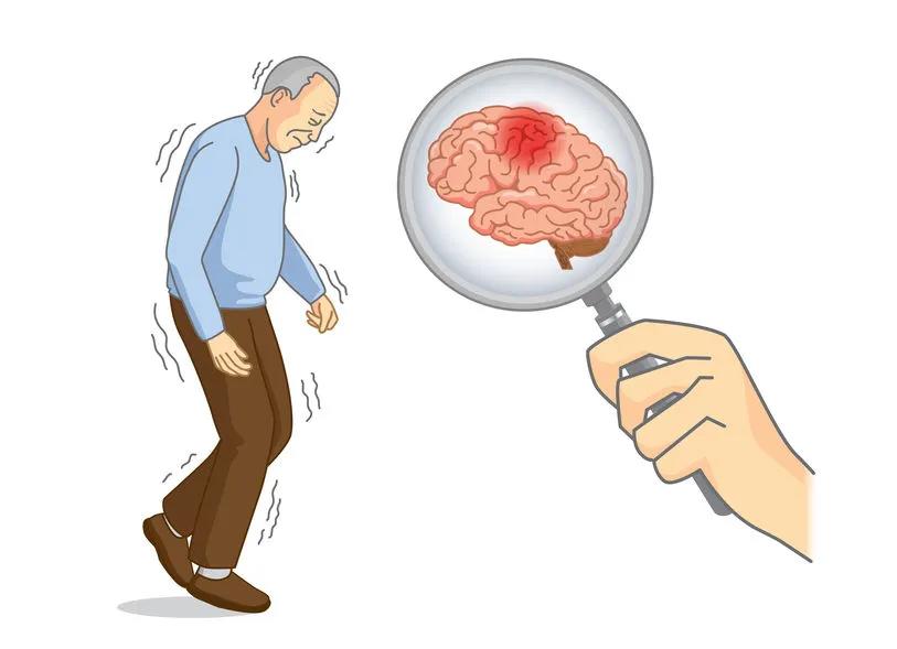 看見爸媽不自覺手抖？要警惕他們得這種病