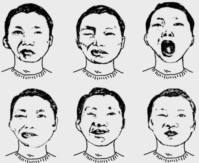 “賣萌”的C叔：其實我心裏很苦！——談談梅傑氏綜合征