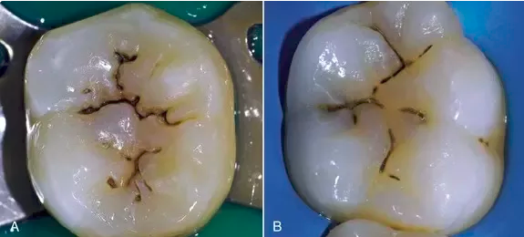 后牙槽上有着謎之黑線，是我沒刷乾淨嗎？