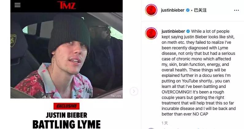 被蜱叮咬要小心，可能會感染萊姆病！