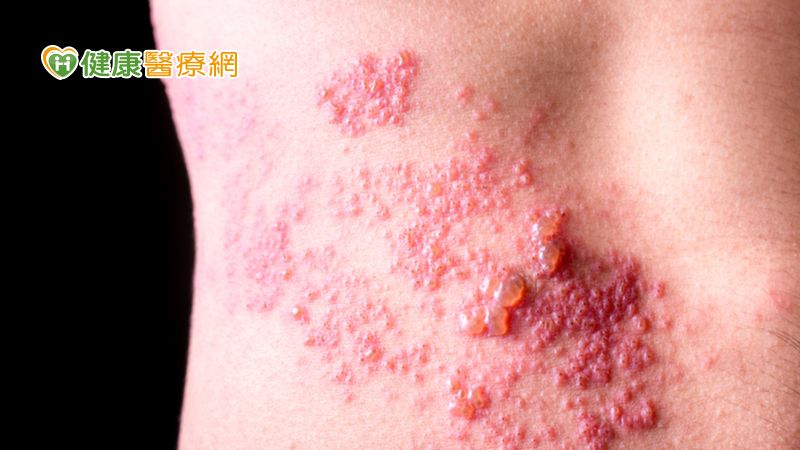 流感季來了! 口罩可防「流感、肺炎」　但「罩」不住「皮蛇」