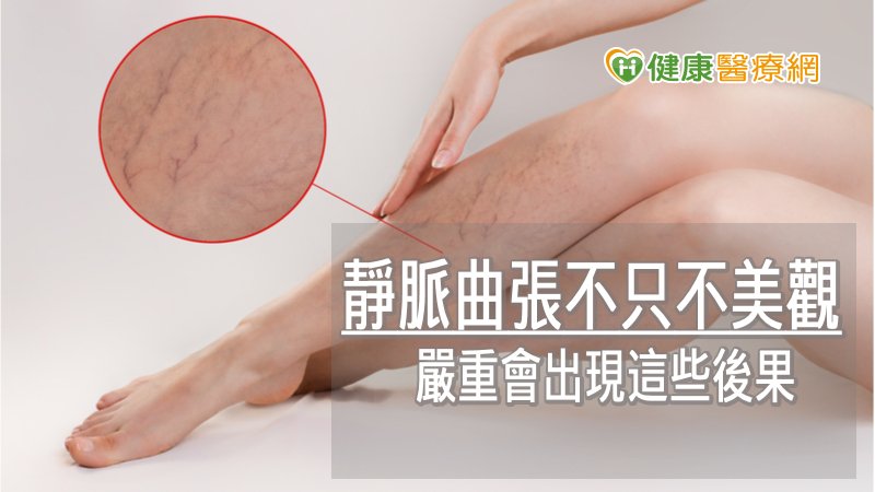 靜脈曲張不只不美觀　嚴重會出現這些後果