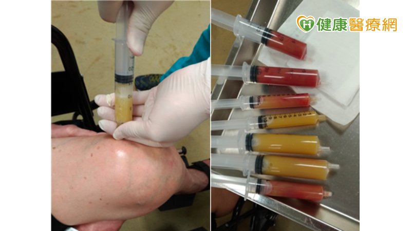 膝蓋痛打一針就好？　錯誤觀念恐害你得不償失_菜花