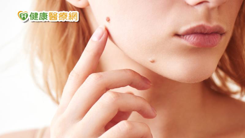 痣跟健康運有關？　４招辨別痣好壞，還有一點須警覺_庫雷斯